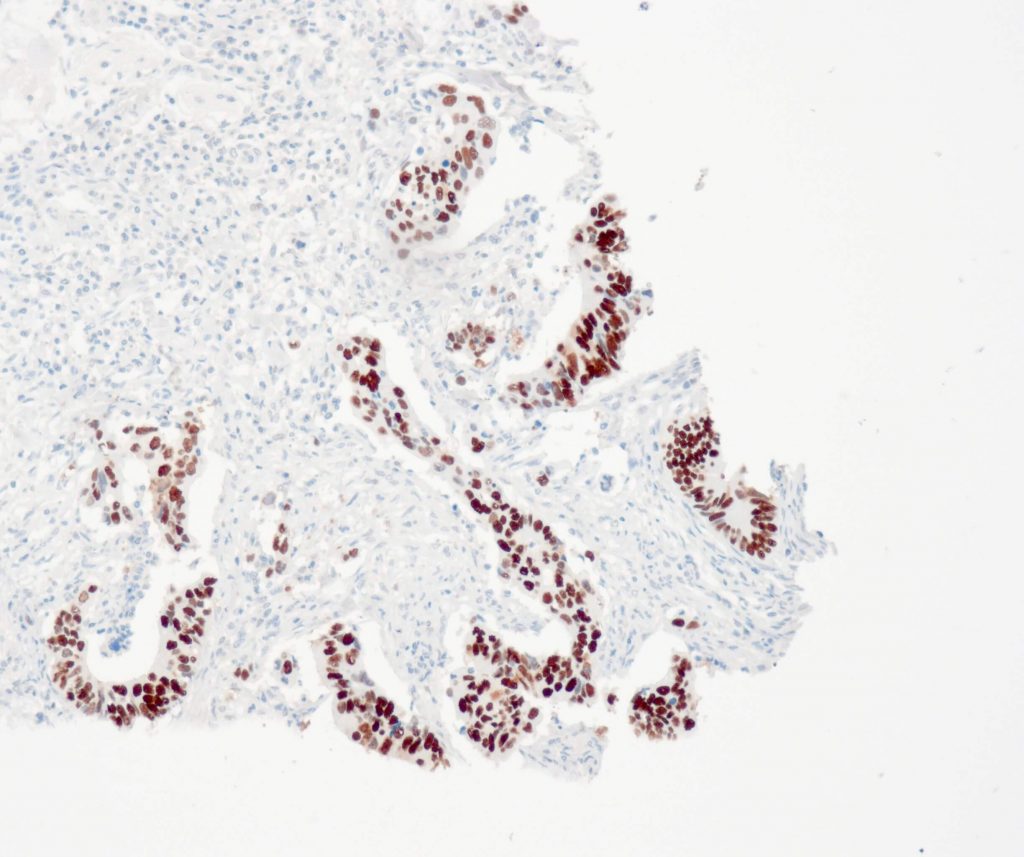 Humanes Adenokarzinom des Kolon gefärbt mit Anti-p53 (QR025) - starke Kernfärbung der Tumorzellen.
