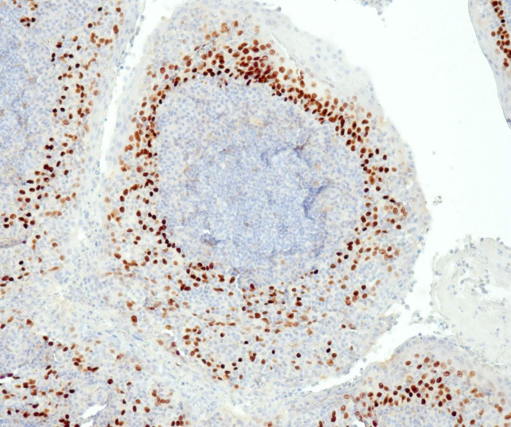 Humane Tonsille gefärbt mit Anti-p63 (QR007) - starke Kernfärbung von Plattenepithelzellen.