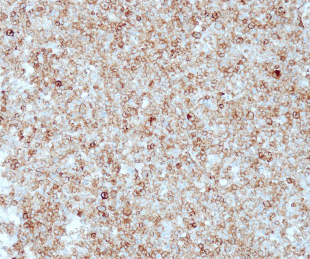 Humanes großzelliges Lymphom gefärbt mit Anti-pan-TRK (QR008).