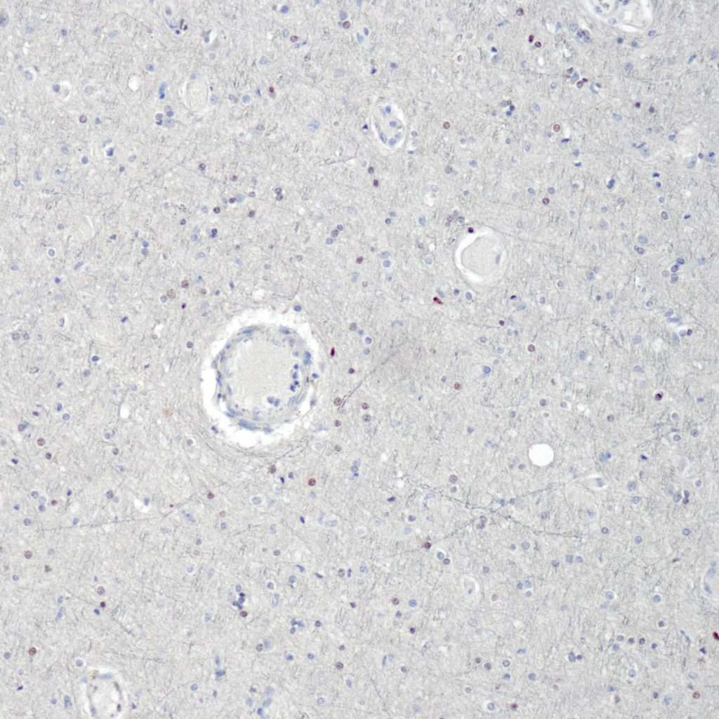 Humanes Gehirn gefärbt mit Anti-Olig2 (QR071) - Kernfärbung von oligodendroglialen Zellen.