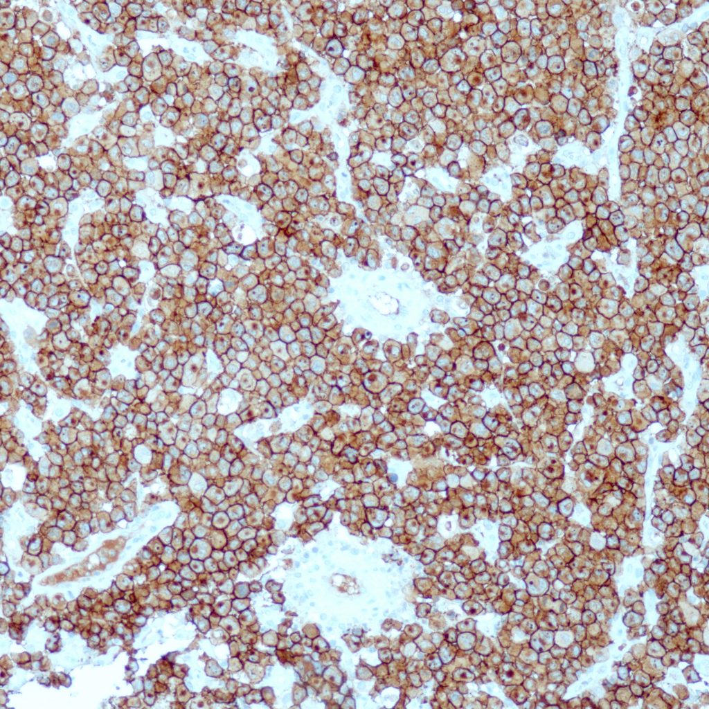 Humanes ALCL gefärbt mit Anti-CD30 (QR109) - stark ausgeprägte Membranfärbung der Tumorzellen.