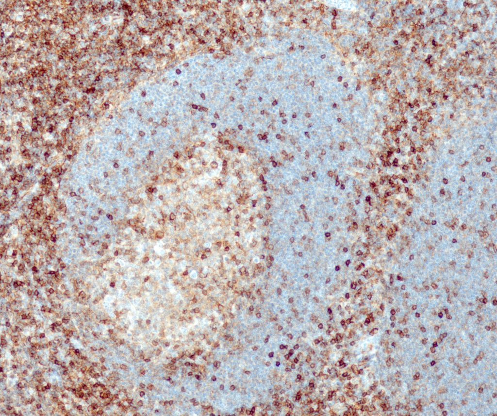 Humane Tonsille gefärbt mit Anti-CD99 (QR067) - starke und deutliche Membranfärbung der basalen und parabasalen Plattenepithelzellen.