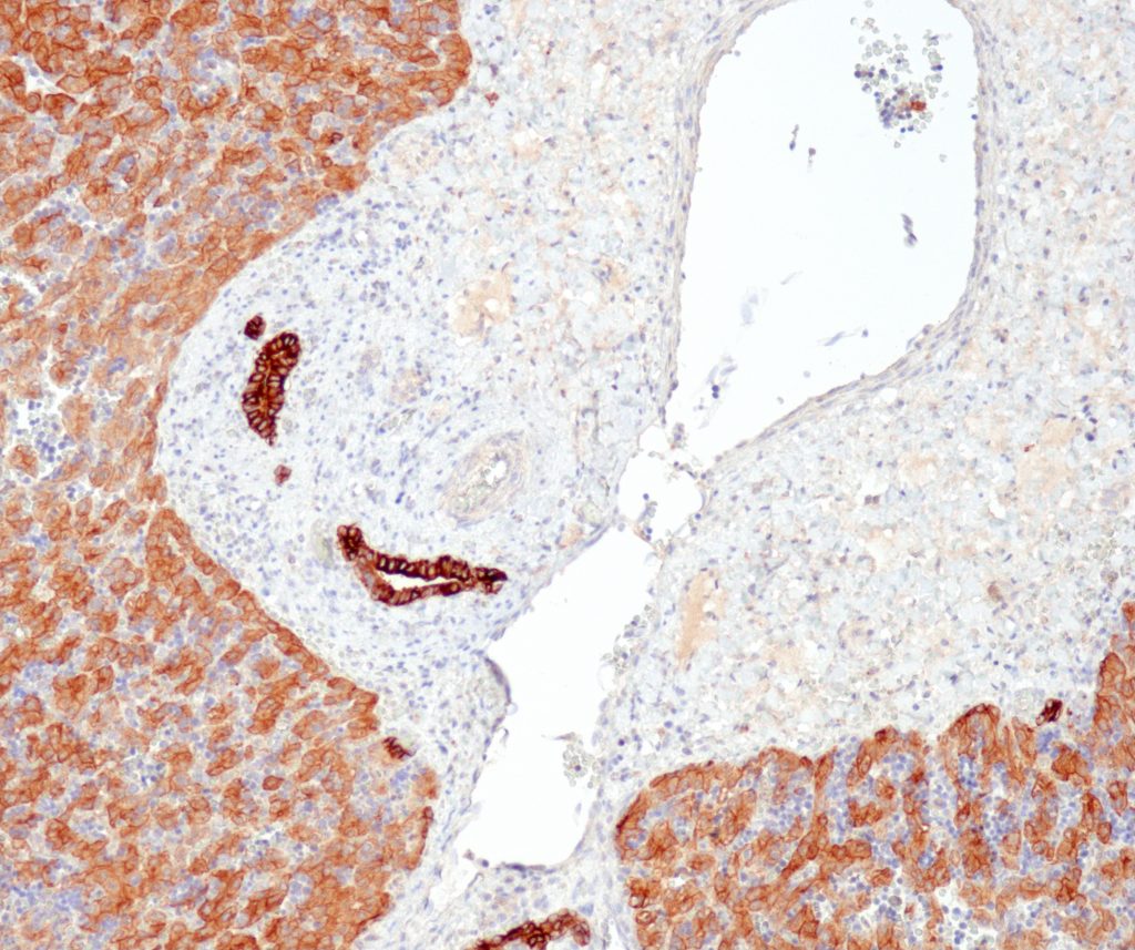 Humane Leber gefärbt mit Anti-CK pan (MNF-116) - mäßige Färbereaktion (mit membranöser Akzentuierung) der überwiegenden Mehrheit der Hepatozyten, Säulenzellen der Gallengänge zeigen eine starke zytoplasmatische Färbereaktion.