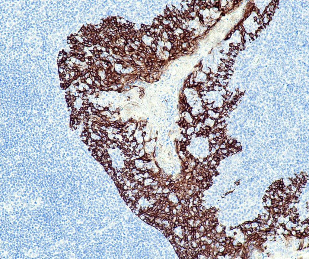 Humane Tonsille gefärbt mit Anti-CK5 (QR027) - starke und deutliche zytoplasmatische Färbung von Plattenepithelzellen.