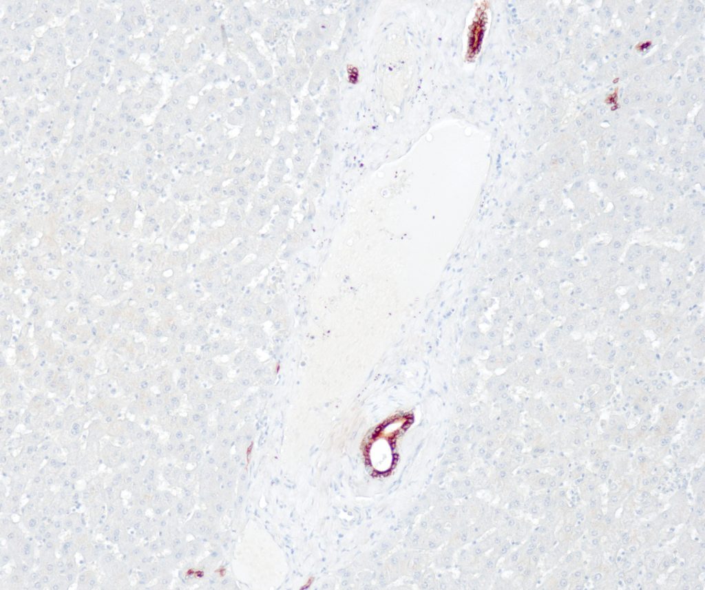 Humane Leber gefärbt mit Anti-CK7 (QR049) - starke, deutliche zytoplasmatische Färbereaktion der Gallengangsepithelzellen. Alle Hepatozyten sind negativ.