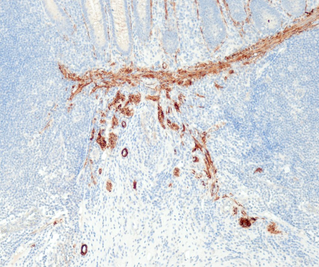 Humaner Appendix gefärbt mit Anti-Caldesmon (QR063).