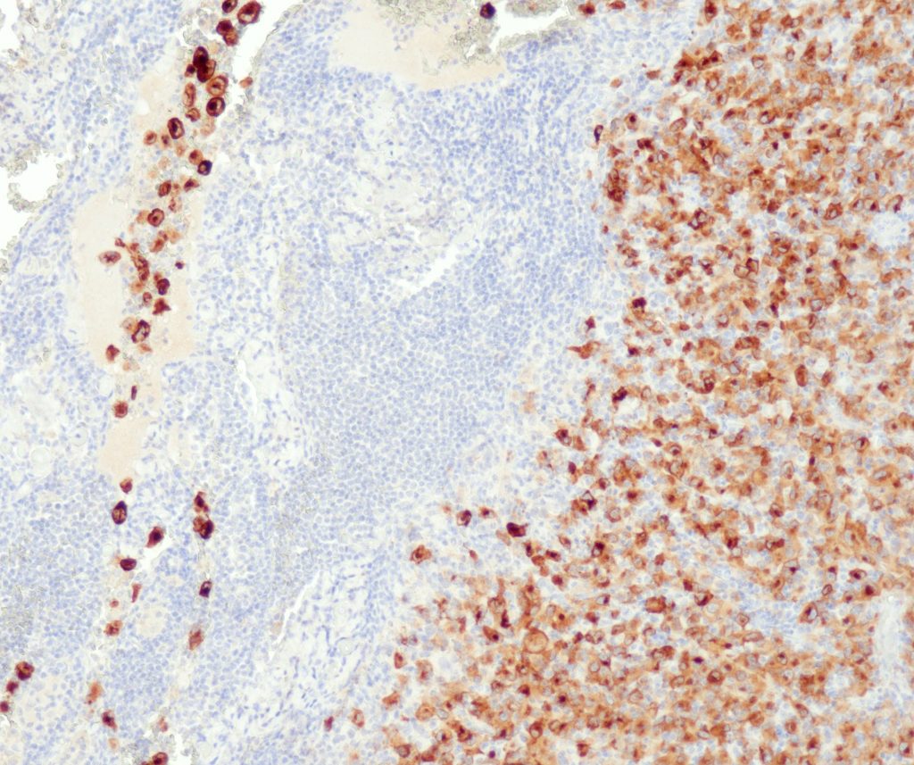 Mit Anti-Melan A (A103) gefärbtes menschliches Melanom – starke zytoplasmatische Färbung von Tumorzellen.