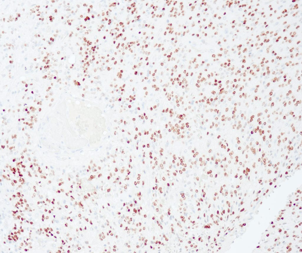 Humanes Gehirn gefärbt mit Anti-Olig2 (QR071) - Kernfärbung von oligodendroglialen Zellen.