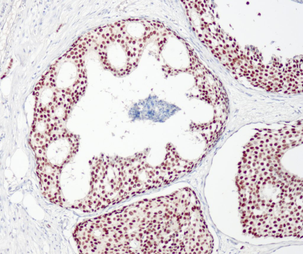 Humanes invasives Mammakarzinom gefärbt mit Anti-TRPS1 (QR099) - Kernfärbung von Tumorzellen.