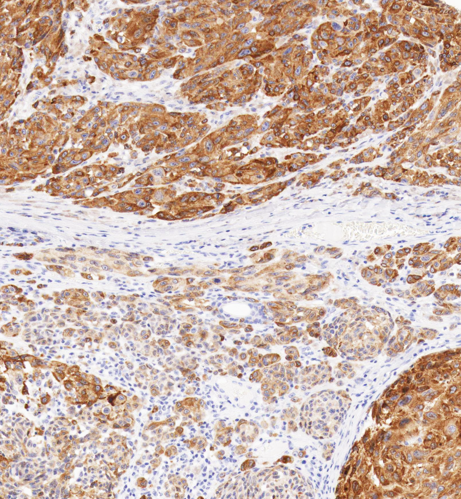 Mit Anti-Tyrosinase (T311) gefärbtes menschliches Melanom – starke zytoplasmatische Färbung von Tumorzellen.