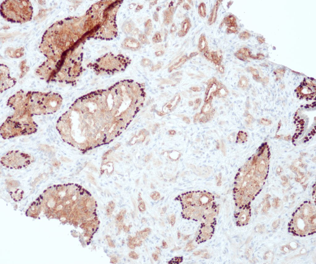 Humanes Prostatakarzinom gefärbt mit Anti-Pin-Cocktail - AMACR: zytoplasmatische und luminale Färbung der Karzinomdrüsen; p63: Basalzellkernfärbung.